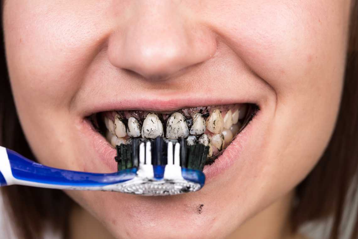Blanqueamiento dental con carbon activado