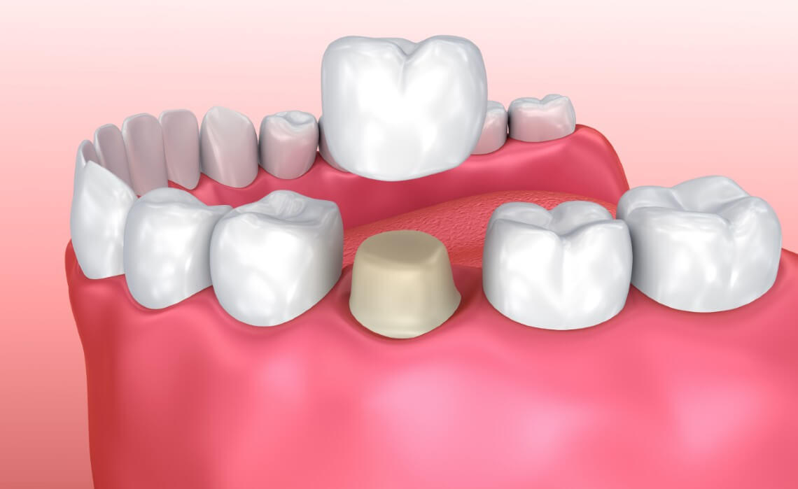 Colocación de corona dental 3D