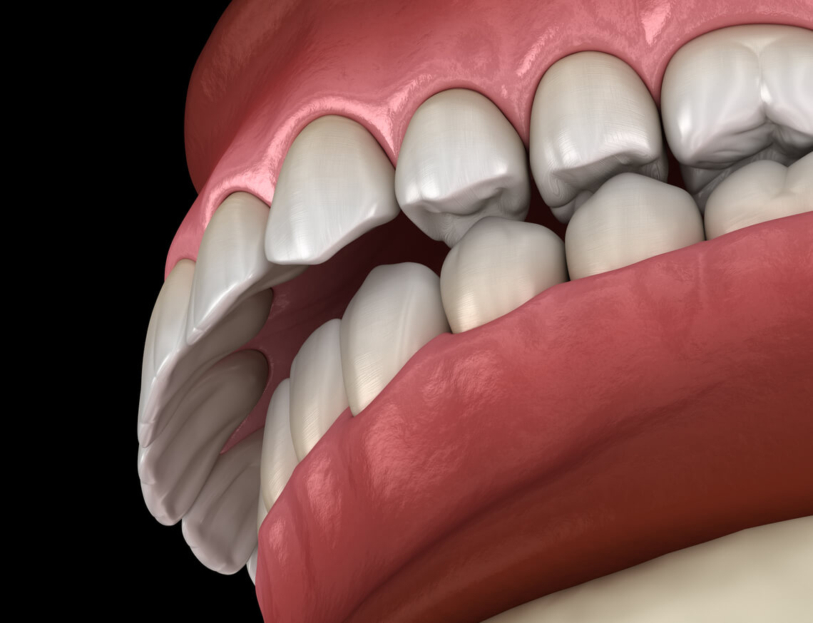 biprotrusión dentaria dientes salidos