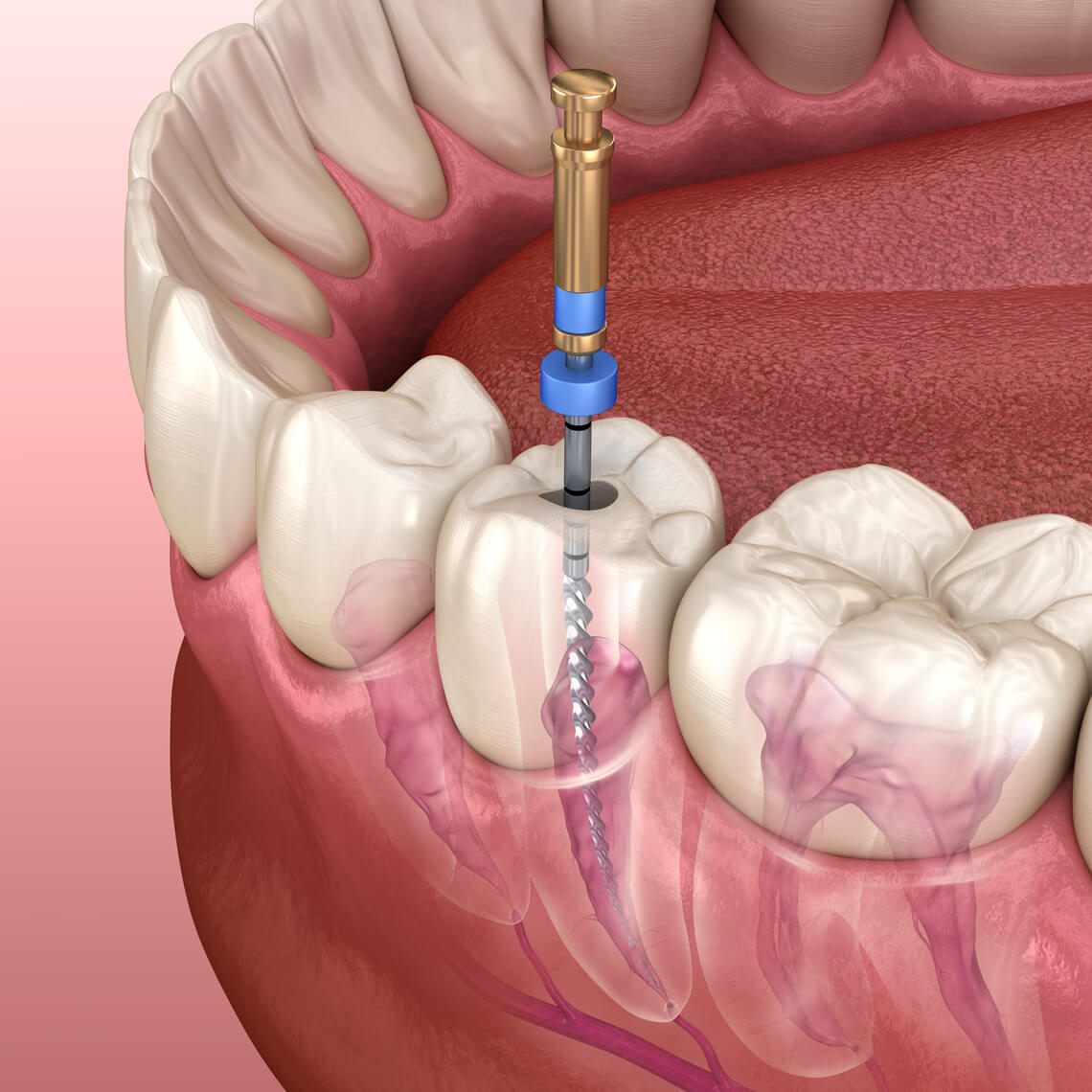 Endodoncia todo lo que necesitas saber