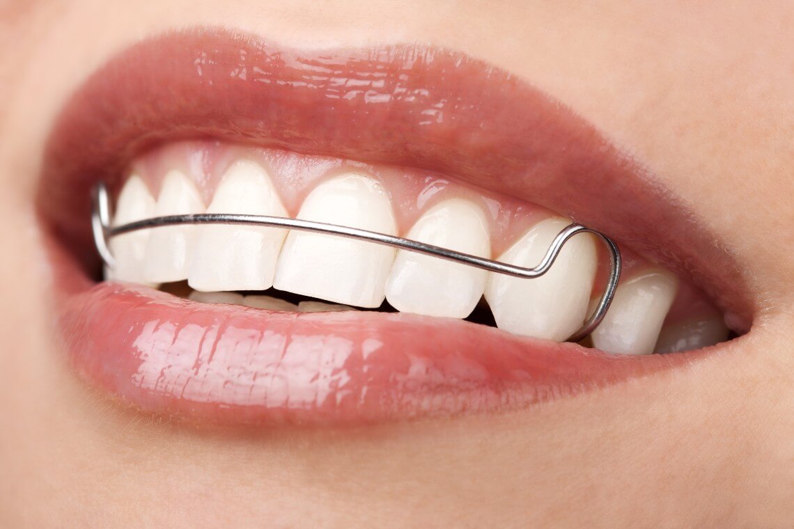 velocidad cortar canal Retenedores dentales: sonrisa perfecta durante más tiempo