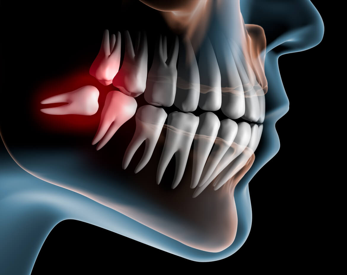 táctica Pef Sociable Pierde el miedo a la extracción de las muelas del juicio | Clínica dental  Tiiz