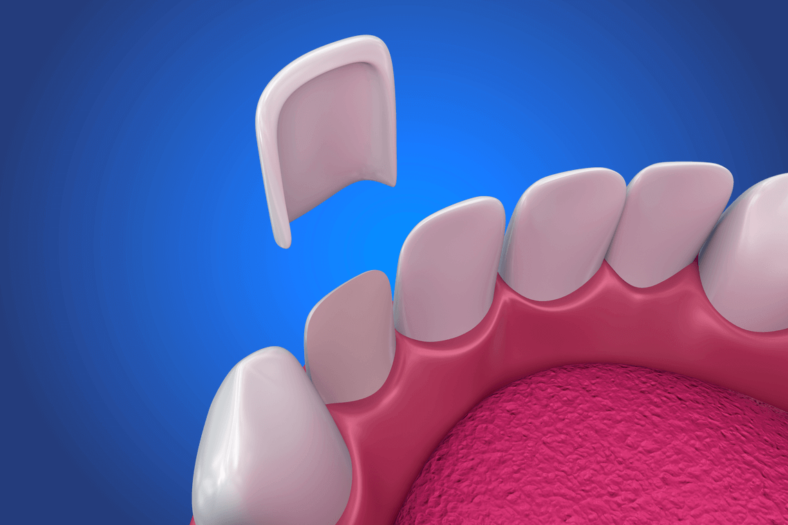 Carillas dentales cuándo utilizarlas