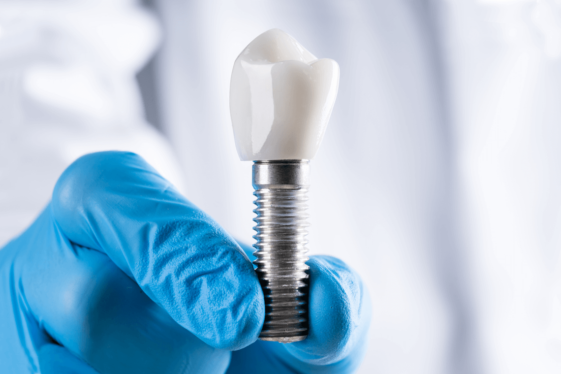 Implantología corona e implante titanio