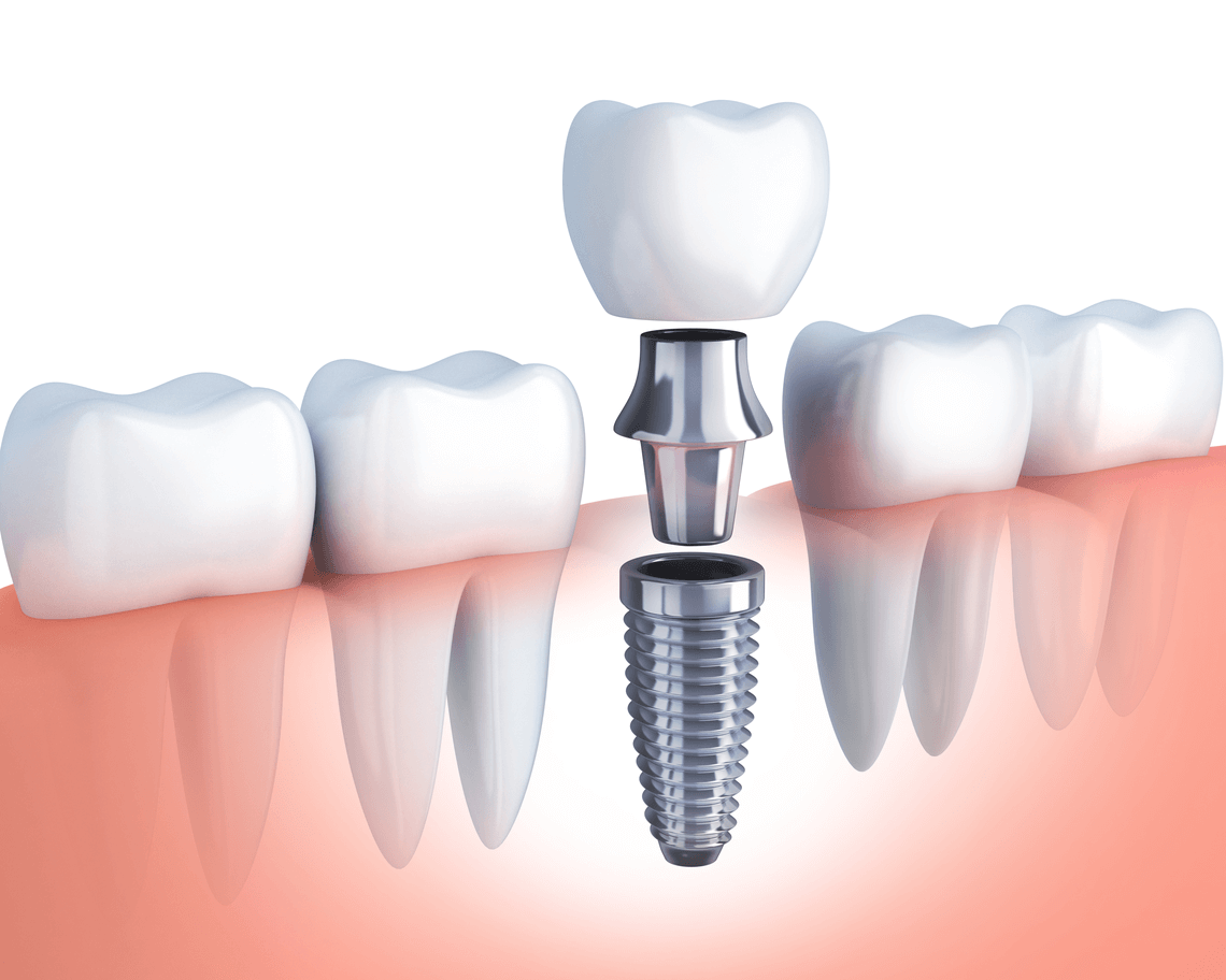 Problemas con implantes dentales